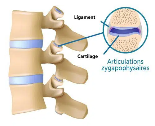 shéma d'arthrose zygapophysaire
