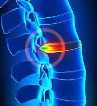 pincement discal c5 c6 quel traitement