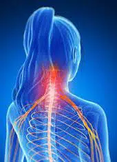 discopathie c5 c6 image 3d