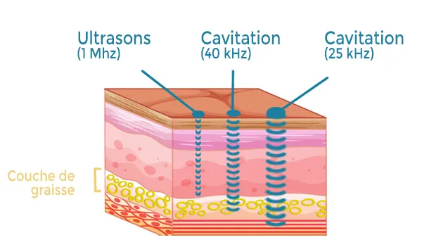 shema fréquence ultrason 1mhz vs cavitation 40khz